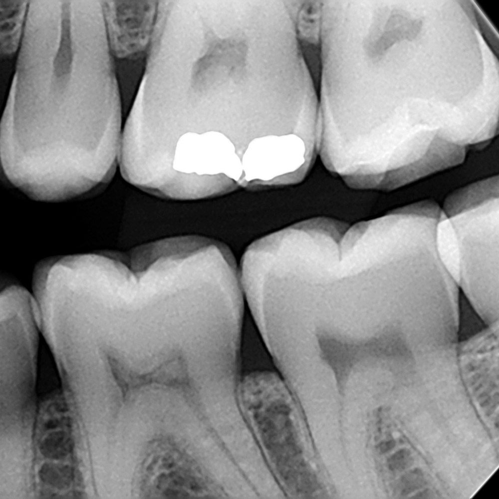 Особенности правильной расшифровки рентгена зубов