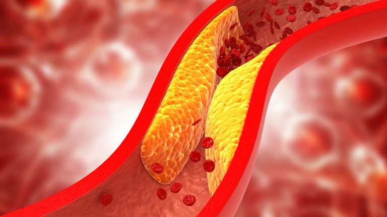 Полезный и вредный холестерин: влияние на организм и снижение рисков д